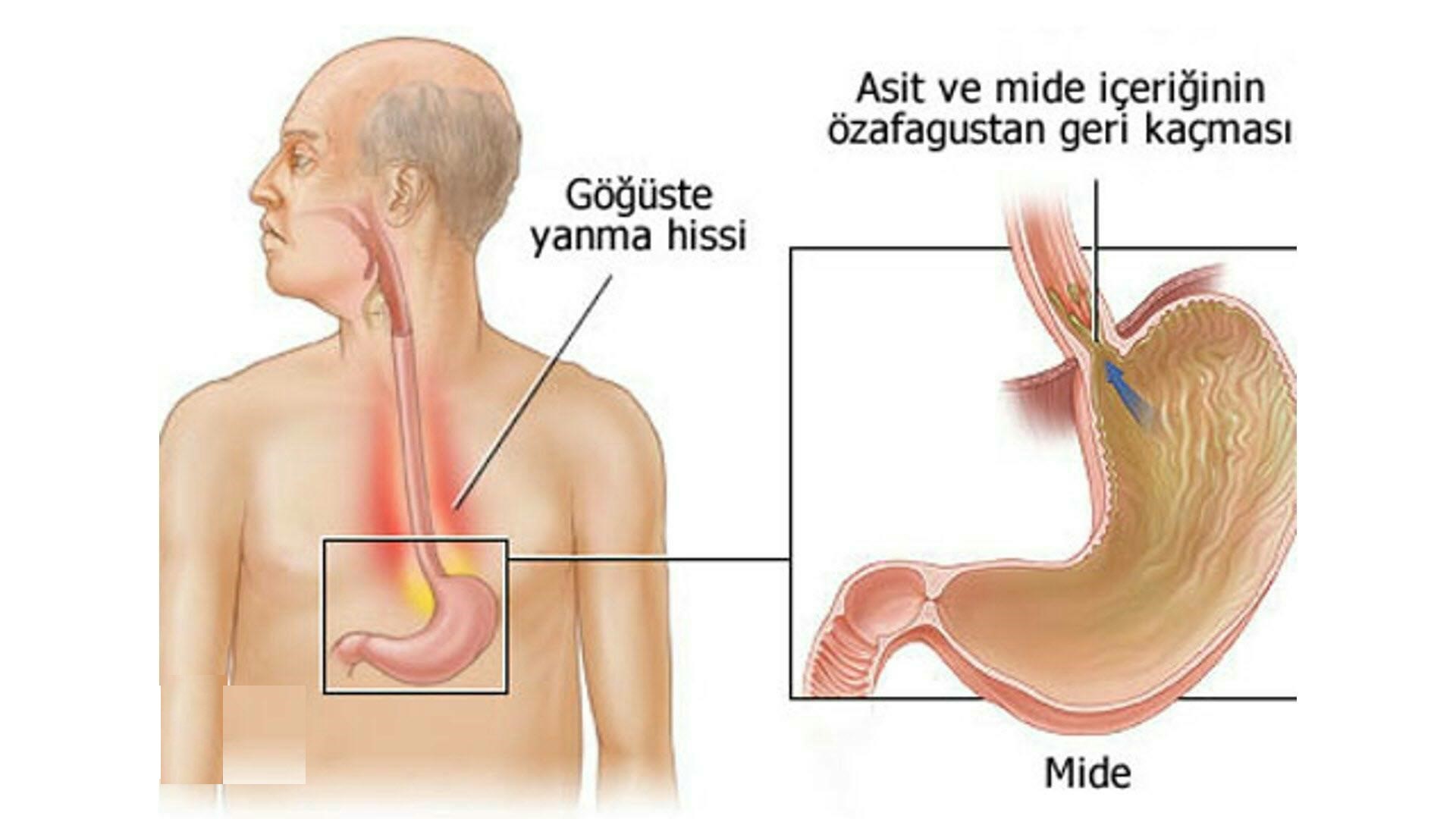Yemek_borusu_hastalıkları